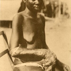 Belgian Congo Woman with Elephantiasis